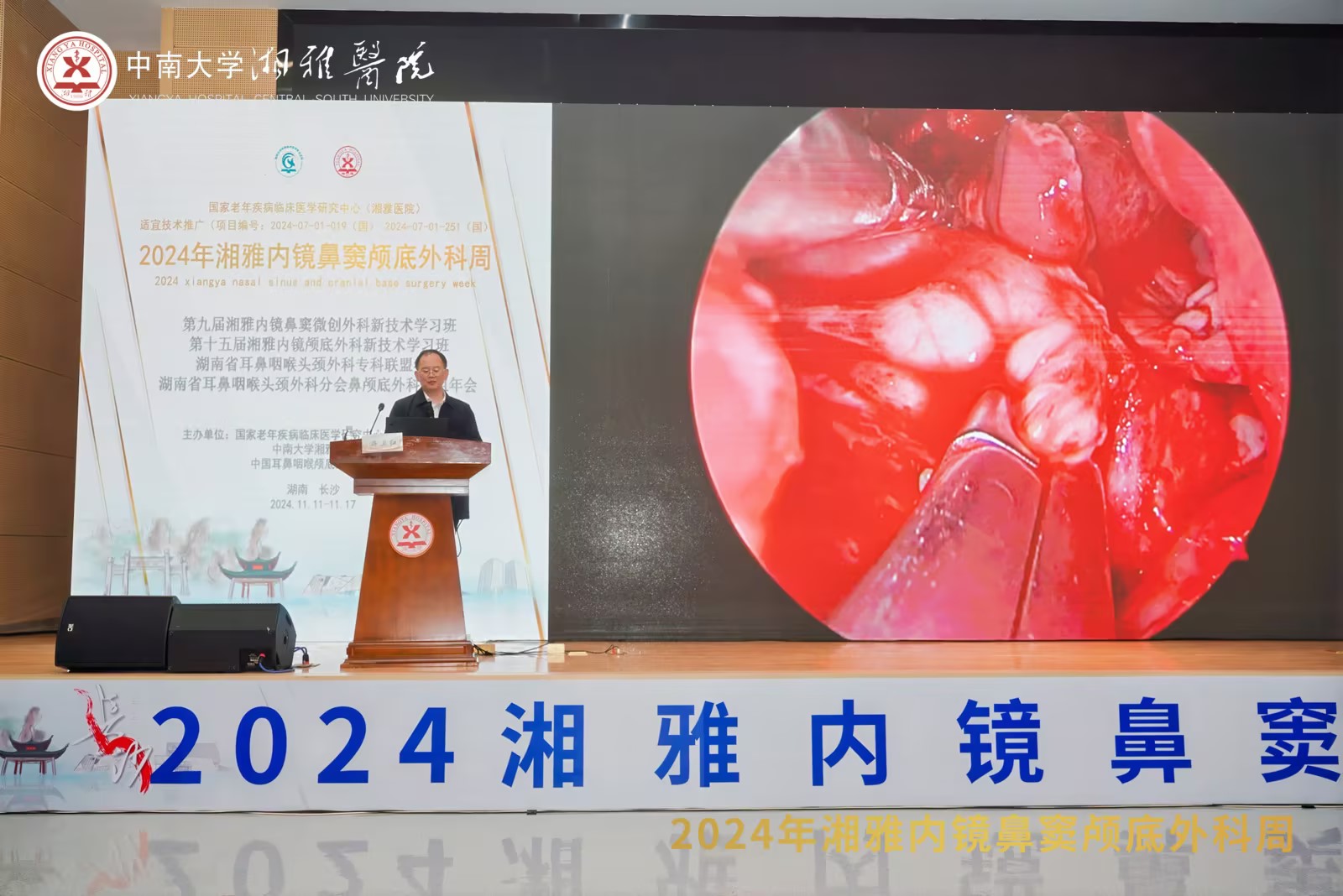 夹式双级、钨针术中利用亮相2024湘雅内镜鼻窦颅底表科周